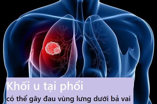 Khối u tại phổi có thể gây đau vùng lưng dưới bả vai